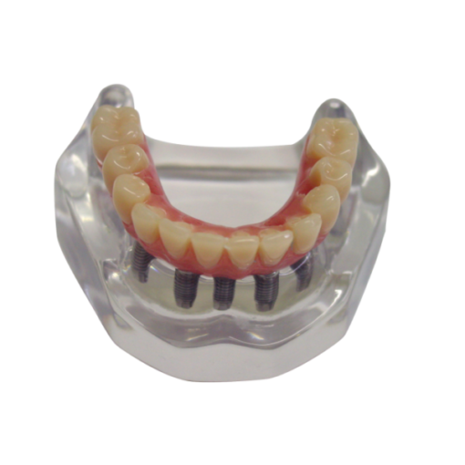 Macro modelo completo Protocolo de Branemark com 5 implantes