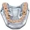 Mandíbula Acrílica Transparente com Dentes e 3 Implantes + Brinde 2 Chaveiros Metálicos