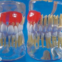 Modelo Doença Periodontal em Acrílico Transparente